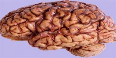 Beyin Damar Tkankl Tedavisi