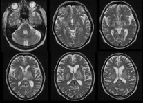 Beyin Mr Nedir ve Nasıl Yapılır?